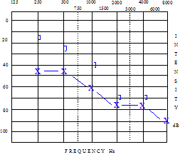 Audiogram showing mixed hearing loss.