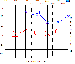 Audiogram showing sensori-neural hearing loss.